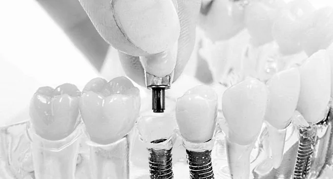Implantat im Knochen